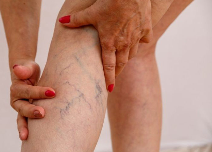 Người bị giãn tĩnh mạch có nên ngâm chân nước nóng