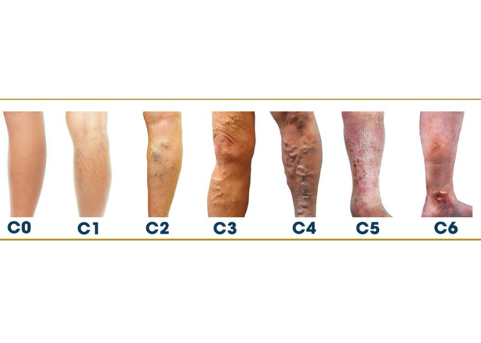 Nhận diện bệnh suy tĩnh mạch chi dưới 