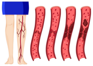 Nhận diện bệnh suy tĩnh mạch chi dưới