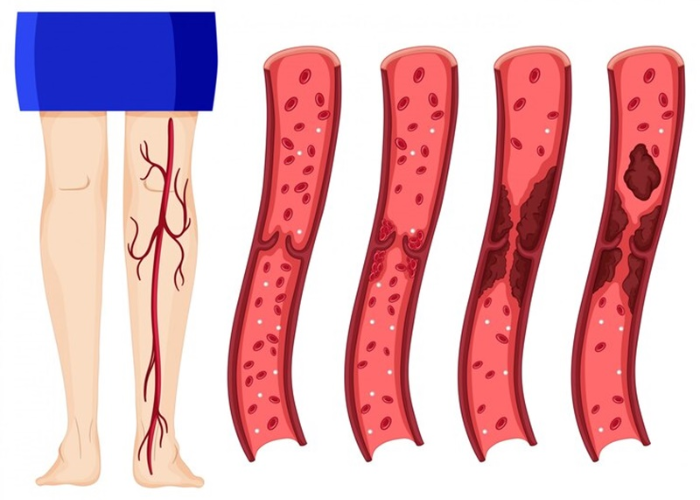 Nhận diện bệnh suy tĩnh mạch chi dưới