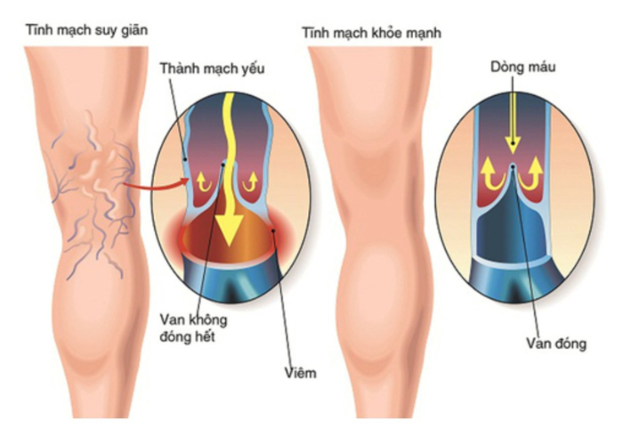 Nhận diện bệnh suy tĩnh mạch chi dưới