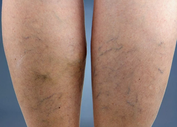 Phân biệt suy giãn tĩnh mạch nông và sâu 