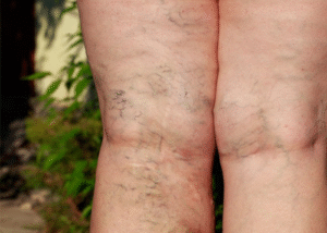 Phân biệt suy giãn tĩnh mạch nông và sâu