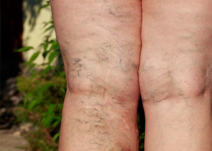 Phân biệt suy giãn tĩnh mạch nông và sâu 