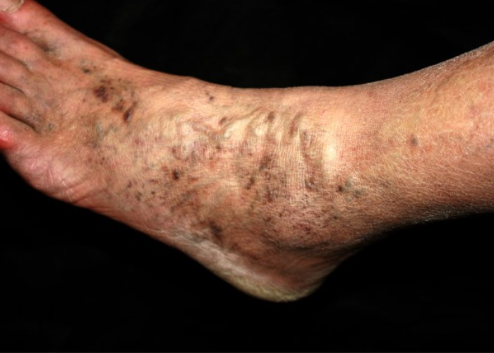 Phân biệt suy giãn tĩnh mạch nông và sâu