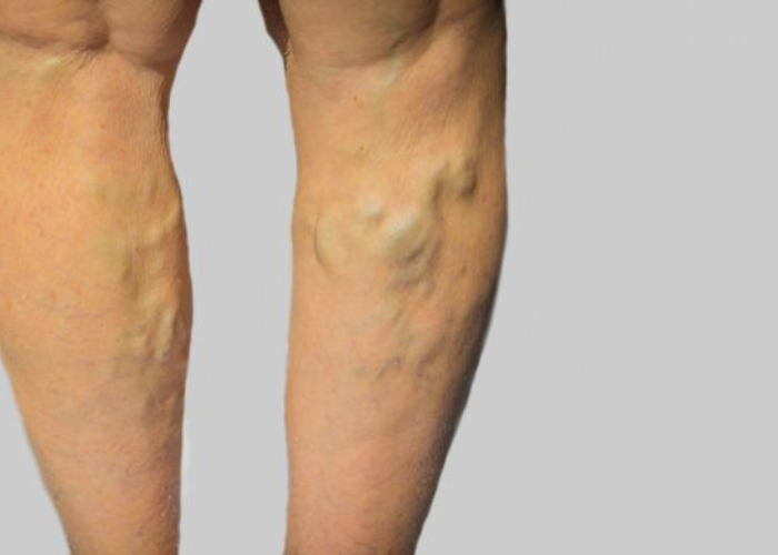 Phân biệt suy giãn tĩnh mạch nông và sâu 