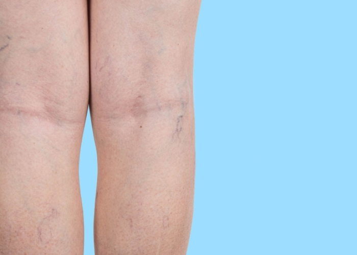 Suy giãn tĩnh mạch có nên đi bộ hay chạy bộ không