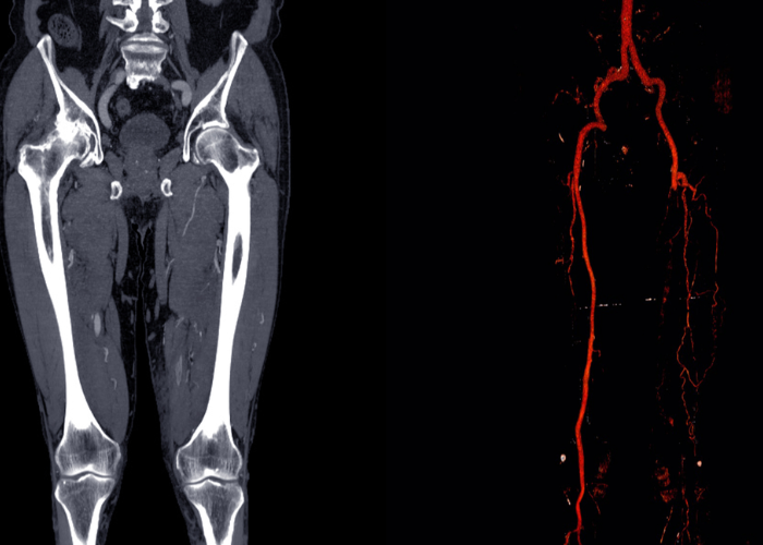 Suy van tĩnh mạch hiển lớn/hiển bé