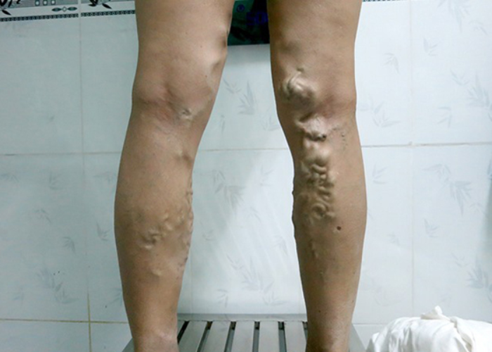 Tác hại của việc đi giày cao gót đối với tĩnh mạch 