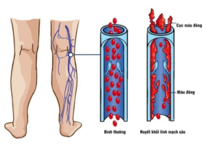 Viêm tắc tĩnh mạch nông