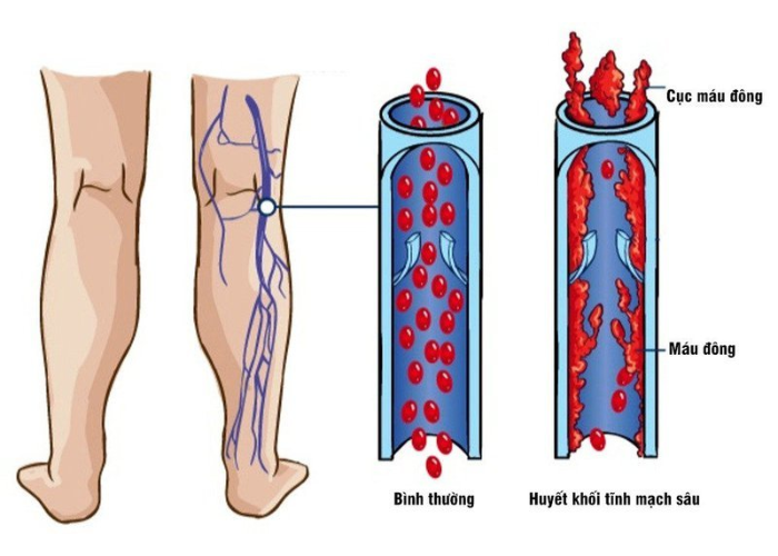 Viêm tắc tĩnh mạch nông