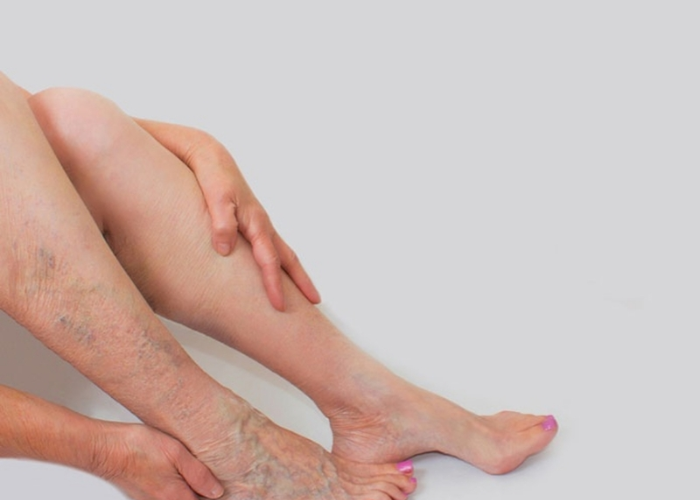 Yoga cho người suy giãn tĩnh mạch chân tại nhà